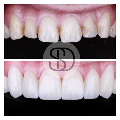 Full Mouth Restoration with Zirconia Crowns Case 6