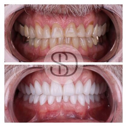 Full Mouth Restoration with Zirconia Crowns Case 7