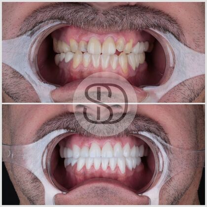 Full Mouth Restoration with Zirconia Crowns Case 8