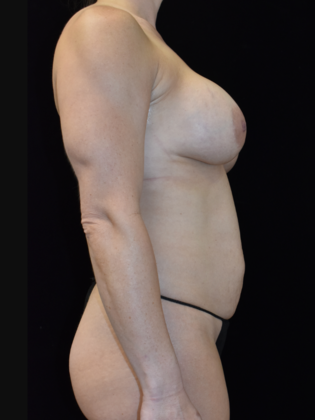 Mommy Makeover: Case 3 - Before