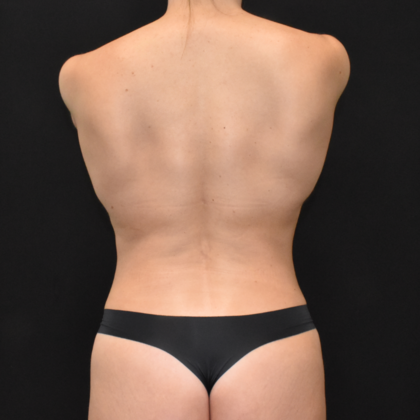 Mommy Makeover: Case 3 - After