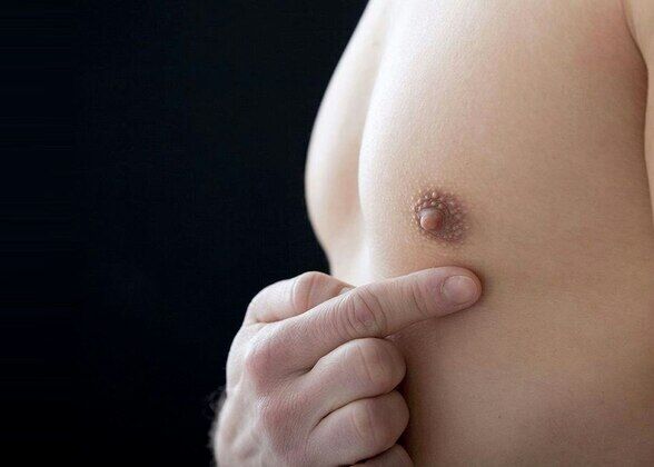 NIPPLE REDUCTION Cases