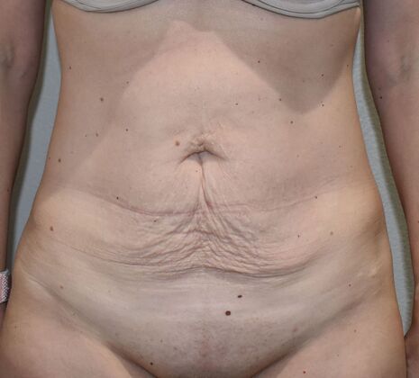 Tummy Tuck (Abdominoplasty): Case 439 - Before