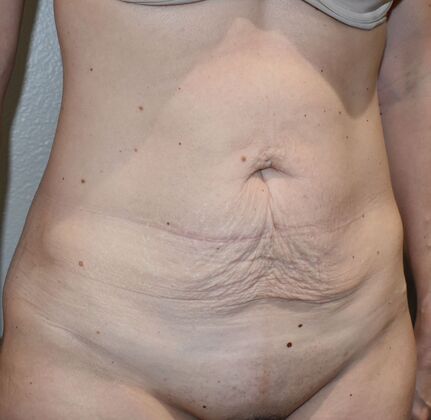 Tummy Tuck (Abdominoplasty): Case 439 - Before