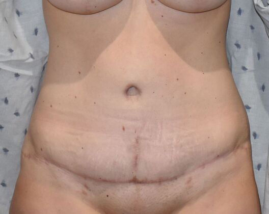 Tummy Tuck (Abdominoplasty): Case 439 - After