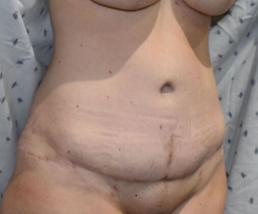 Tummy Tuck (Abdominoplasty): Case 439 - After