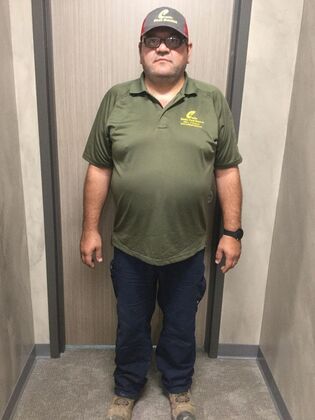 Gastric Sleeve: Case 9 - Before