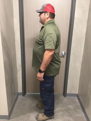 Gastric Sleeve: Case 9 - Before