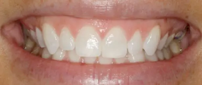 Smile Makeover & Veneers: Case 13 - Before