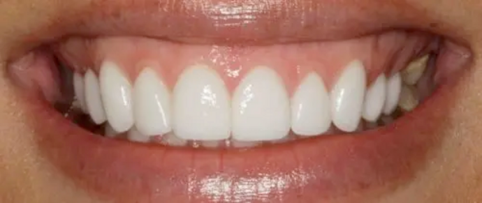 Smile Makeover & Veneers: Case 13 - After