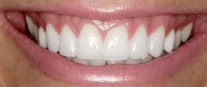 Smile Makeover & Veneers: Case 18 - After