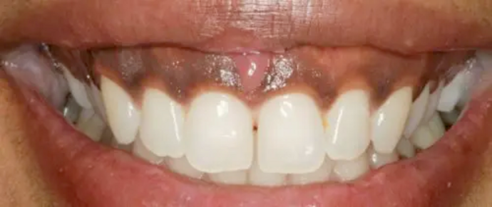 Smile Makeover & Veneers: Case 21 - Before