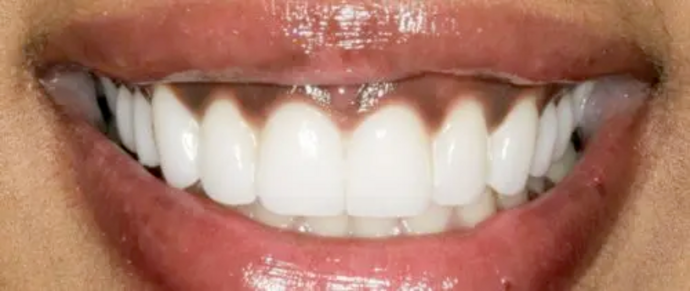 Smile Makeover & Veneers: Case 21 - After