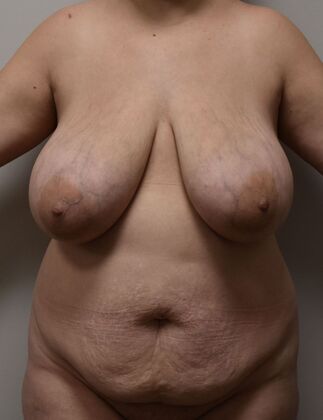 Mommy Makeover Case 287 - Before