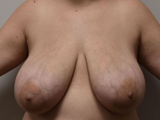 Breast Reduction Case 169 - Before