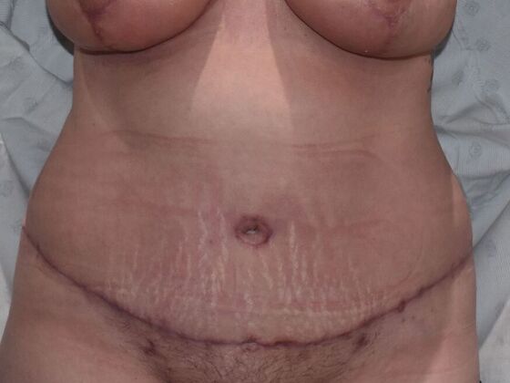 Tummy Tuck (Abdominoplasty): Case 440 - After