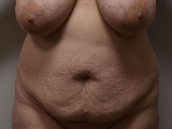 Tummy Tuck (Abdominoplasty): Case 440 - Before