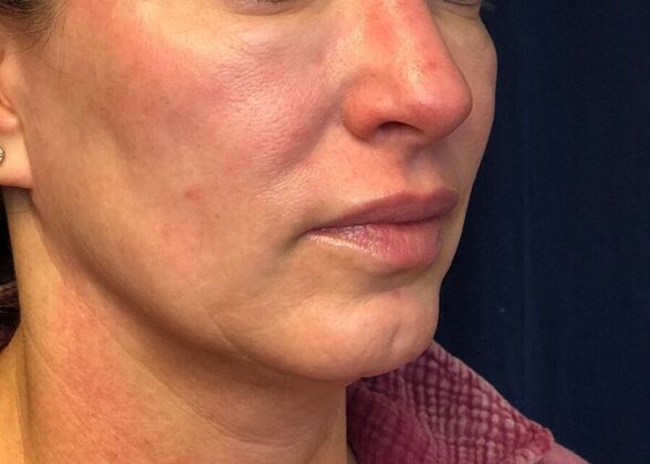 Cosmetic Injectables & Fillers*: Case 49- Cheek Filler - Before