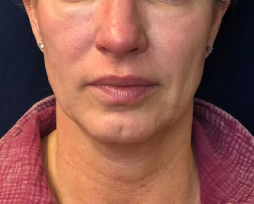 Cosmetic Injectables & Fillers*: Case 49- Cheek Filler - Before