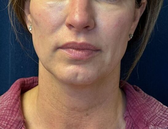 Cosmetic Injectables & Fillers*: Case 49- Cheek Filler - After