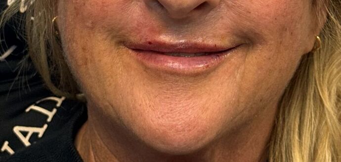 Cosmetic Injectables & Fillers*: Case 50- Lip Filler - After