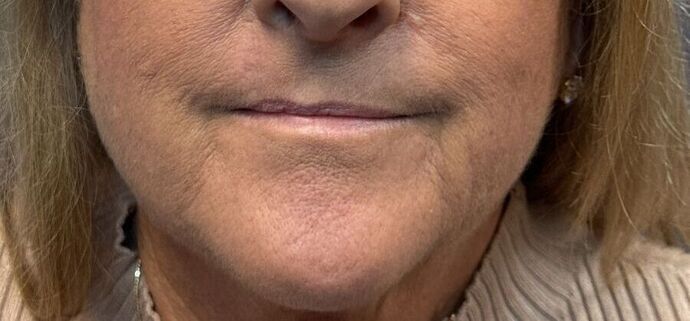 Cosmetic Injectables & Fillers*: Case 50- Lip Filler - Before