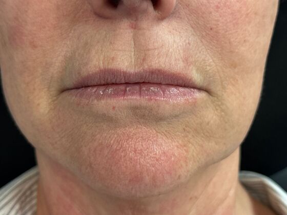 Cosmetic Injectables & Fillers*: Case 51- Lip Filler - Before