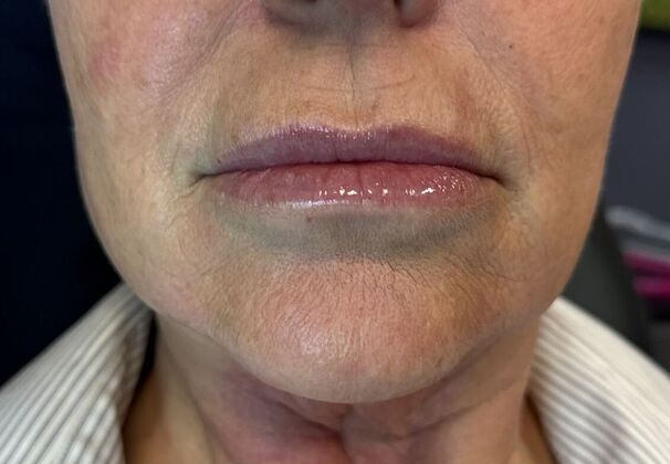 Cosmetic Injectables & Fillers*: Case 51- Lip Filler - After