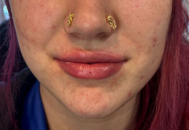 Cosmetic Injectables & Fillers*: Case 52- Lip Filler - After