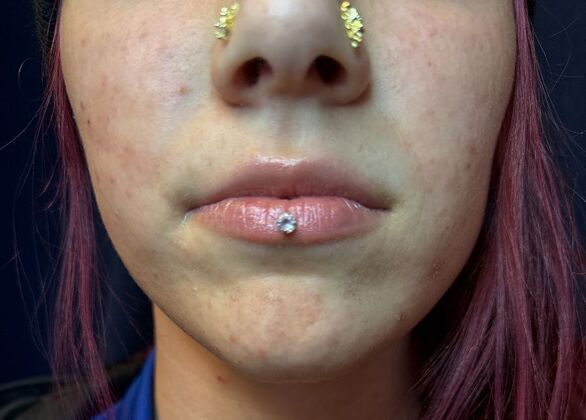 Cosmetic Injectables & Fillers*: Case 52- Lip Filler - Before