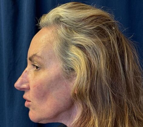 Cosmetic Injectables & Fillers*: Case 53- Cheek Filler - After