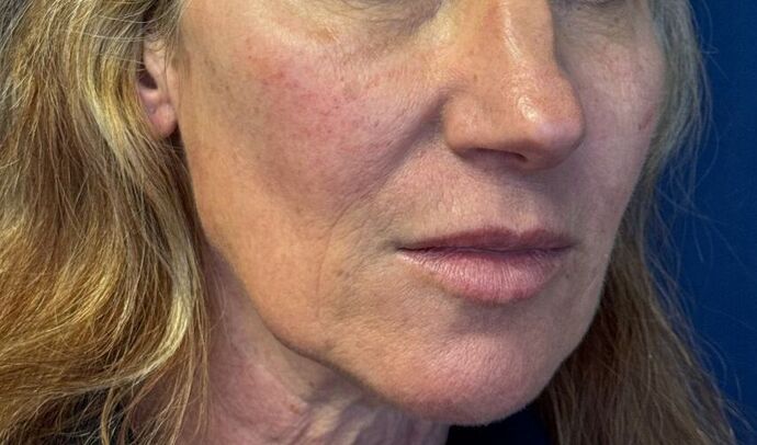 Cosmetic Injectables & Fillers*: Case 53- Cheek Filler - After