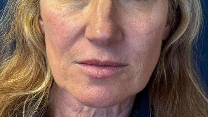 Cosmetic Injectables & Fillers*: Case 53- Cheek Filler - After