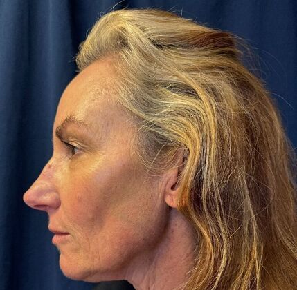 Cosmetic Injectables & Fillers*: Case 53- Cheek Filler - Before