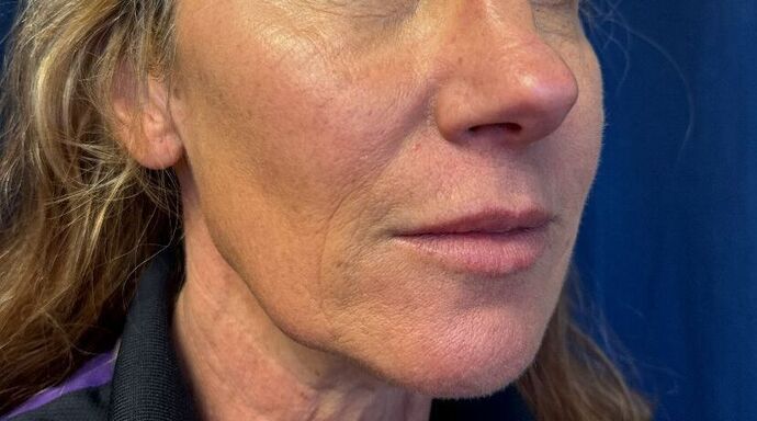 Cosmetic Injectables & Fillers*: Case 53- Cheek Filler - Before