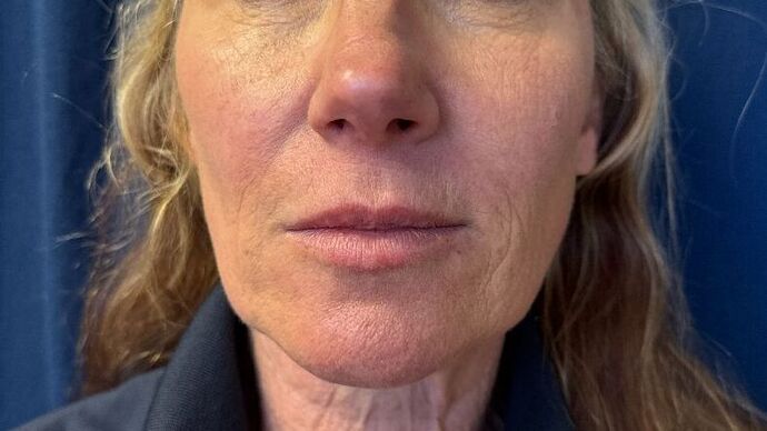 Cosmetic Injectables & Fillers*: Case 53- Cheek Filler - Before