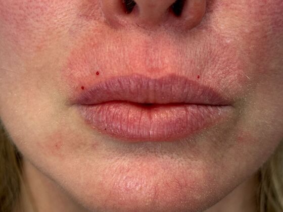 Cosmetic Injectables & Fillers*: Case 54- Lip Filler - After