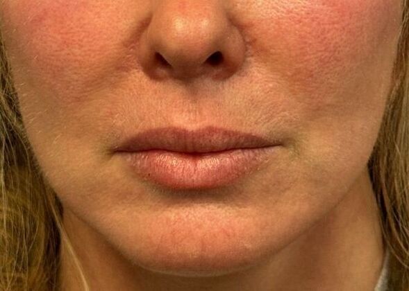 Cosmetic Injectables & Fillers*: Case 54- Lip Filler - Before