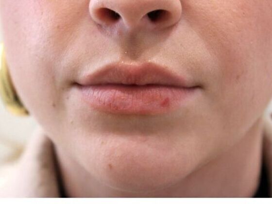 Injectables Case 69 - Before