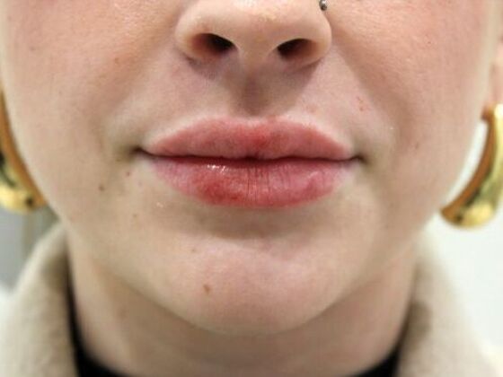 Injectables Case 69 - After