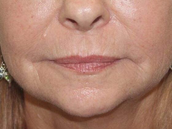 Injectables Case 70 - Before