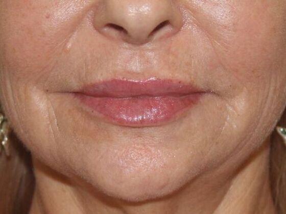 Injectables Case 70 - After