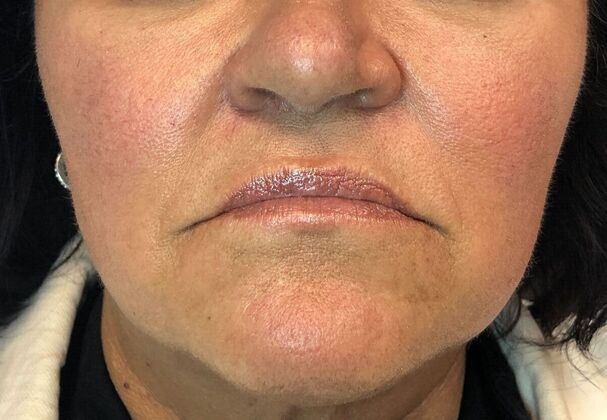 Cosmetic Injectables & Fillers*: Case 55 Lip Filler - Before