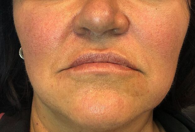 Cosmetic Injectables & Fillers*: Case 55 Lip Filler - After