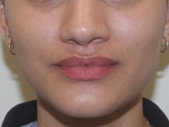 Injectables Case 71 - Before