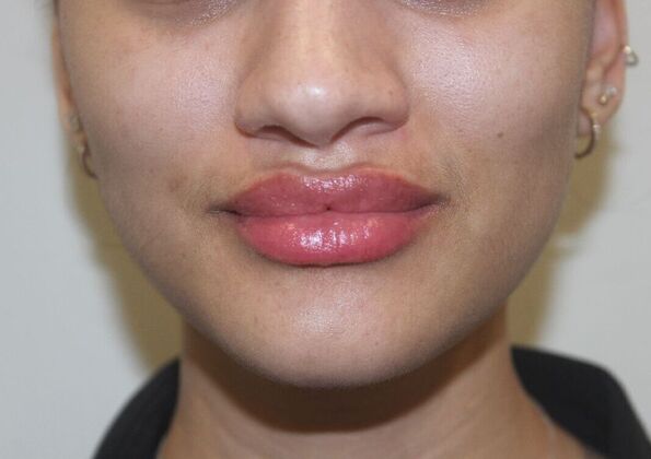 Injectables Case 71 - After