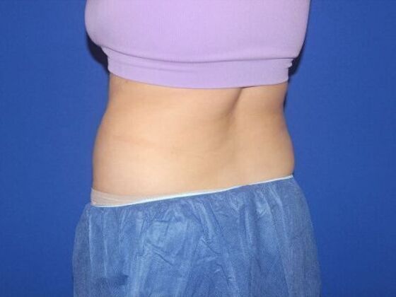 CoolSculpting: Case 10 - Before