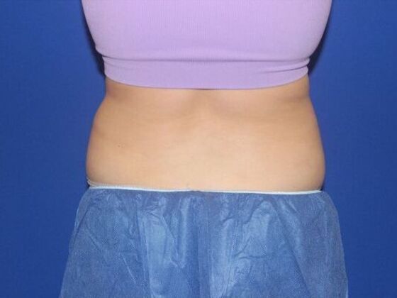 CoolSculpting: Case 10 - Before