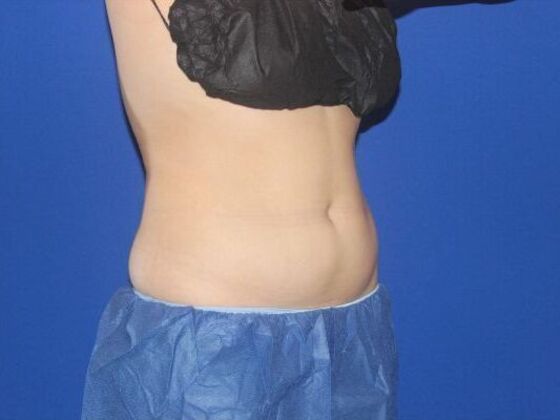 CoolSculpting: Case 10 - After
