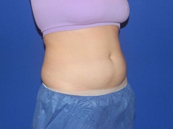 CoolSculpting: Case 10 - Before